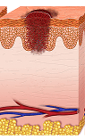 Melanoma en etapa II