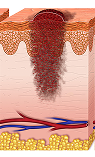 Melanoma en etapa III