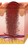 Melanoma en etapa IV