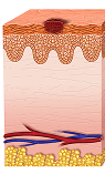 Melanoma en etapa 0 (melanoma in situ)