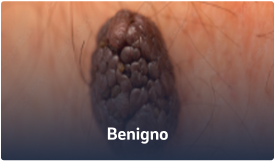 Benigno