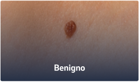 Benigno